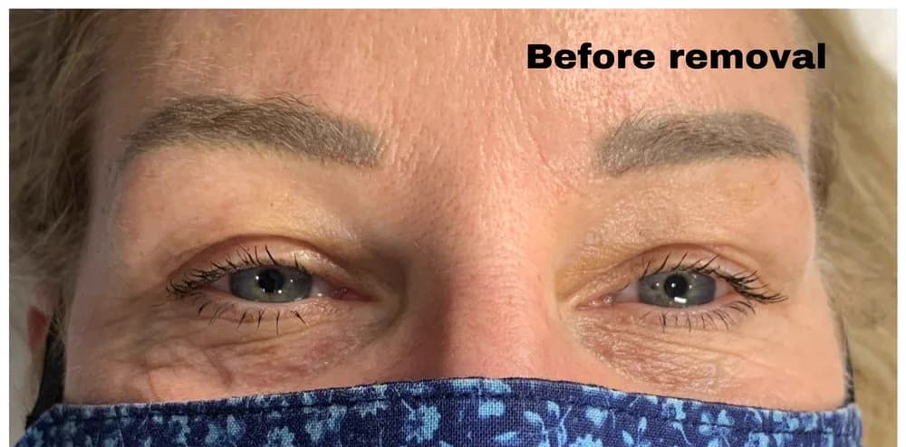 Cool-shifted microblading before non-laser removal — gray / blue pigment (real client)