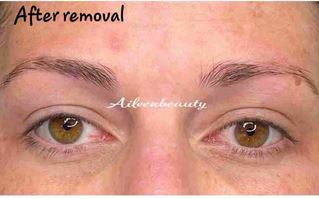 Eyebrow Tattoo Removal