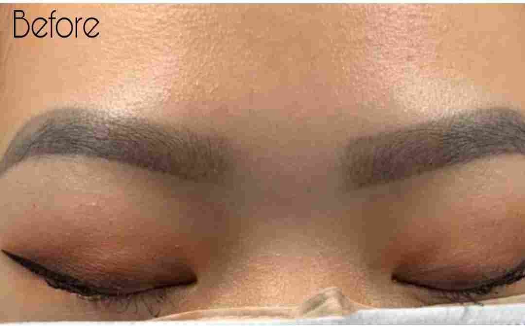 Old microblading before non-laser removal — gray / blue pigment (real client)